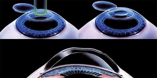 Los mejores oftalmólogos del mundo se reúnen en Mallorca el próximo sábado