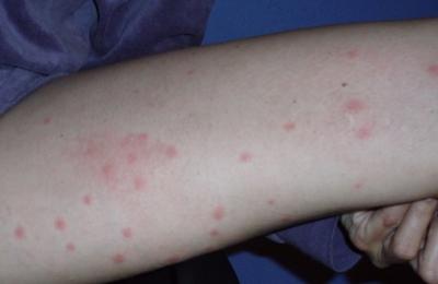 Cort reubica a los niños de las escoletas de Son Ferriol y Son Roca tras una plaga de pulgas y un desprendimiento 