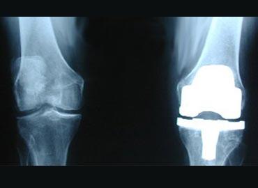 El Hospital de Inca optimiza los implantes de prótesis de rodilla con una nueva técnica