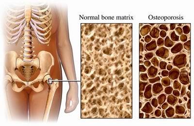 Alcúdia acoge este domingo la Marcha Solidaria del Día Mundial de la Osteoporosis