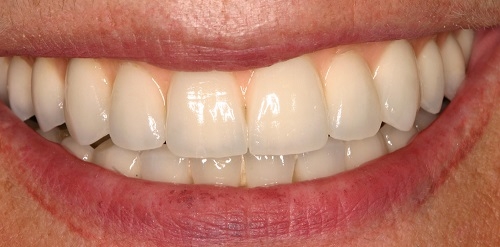 Los laboratorios de prótesis dentales han bajado su facturación entre el 30% y 40% en cinco años