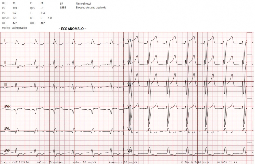 Incorporan una alerta para identificar rápidamente las alteraciones del electrocardiograma que pueden suponer un riesgo para el paciente