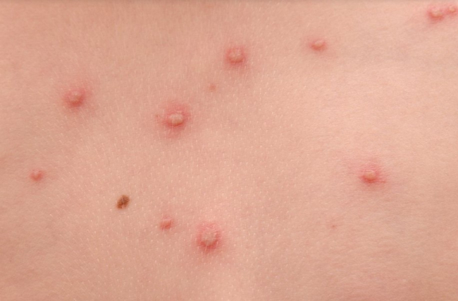 Sanidad emite una alerta tras detectar 22 casos sospechosos de 'viruela del mono'