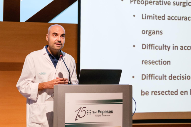 Son Espases mejora el índice de supervivencia del cáncer colorrectal avanzado y reduce las recaídas gracias a un planificador quirúrgico 3D pionero en todo el Estado
